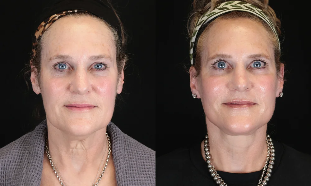 Real patient results in New York, NY Performed by Sameer Halani, MD