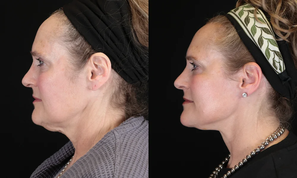 Real patient results in New York, NY Performed by Sameer Halani, MD