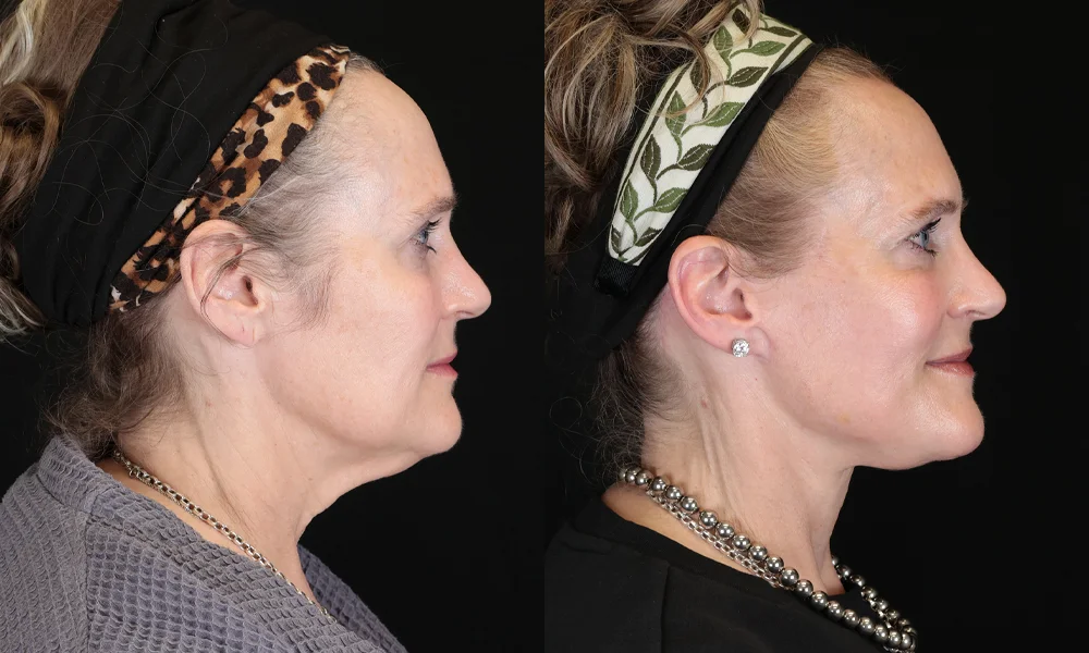Real patient results in New York, NY Performed by Sameer Halani, MD