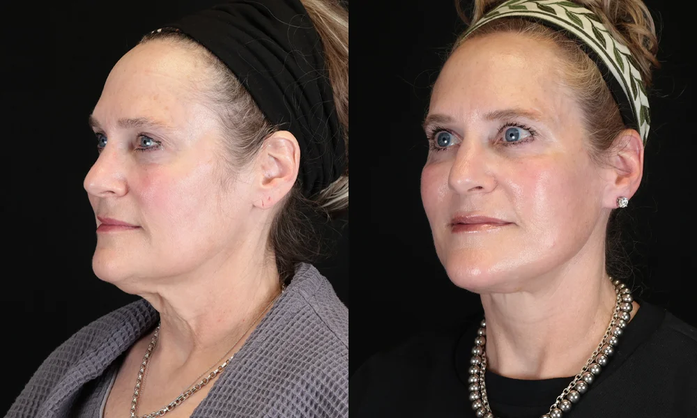 Real patient results in New York, NY Performed by Sameer Halani, MD