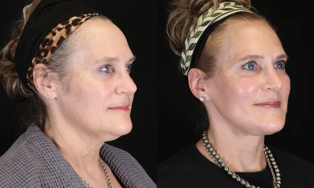 Real patient results in New York, NY Performed by Sameer Halani, MD