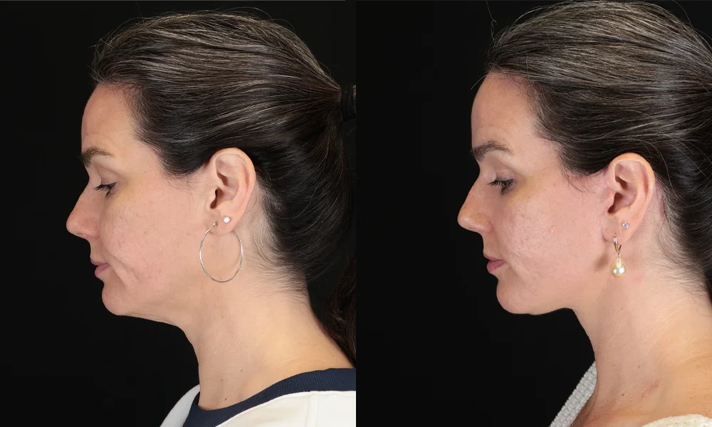 Real patient results in New York, NY Performed by Sameer Halani, MD