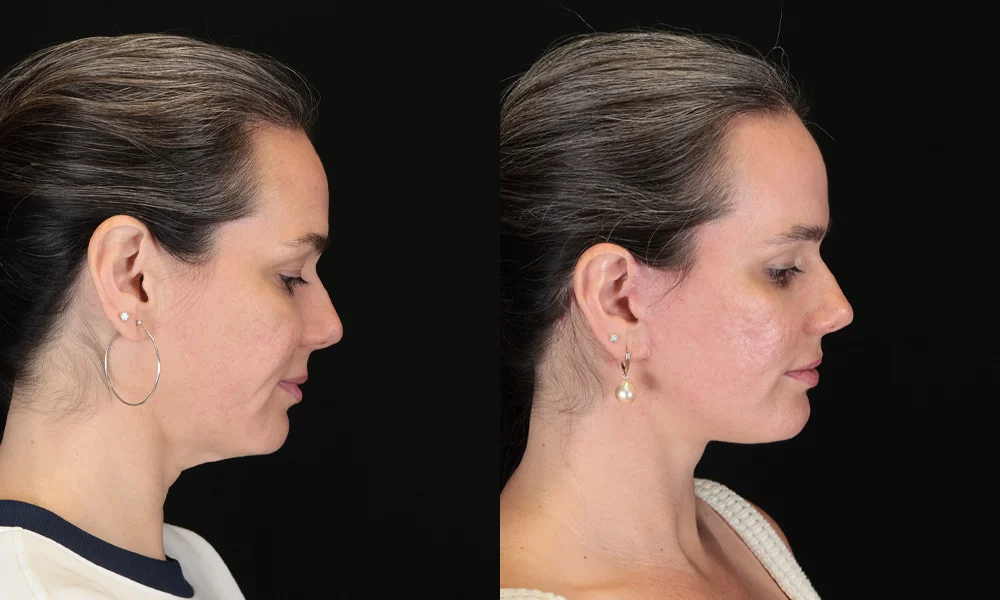 Real patient results in New York, NY Performed by Sameer Halani, MD