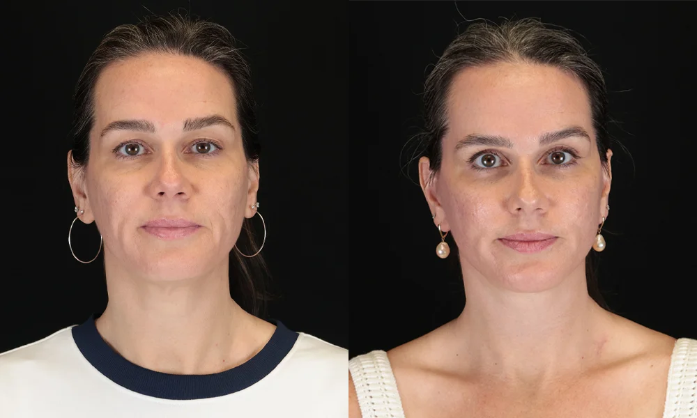 Real patient results in New York, NY Performed by Sameer Halani, MD