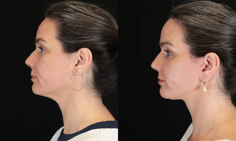 Real patient results in New York, NY Performed by Sameer Halani, MD