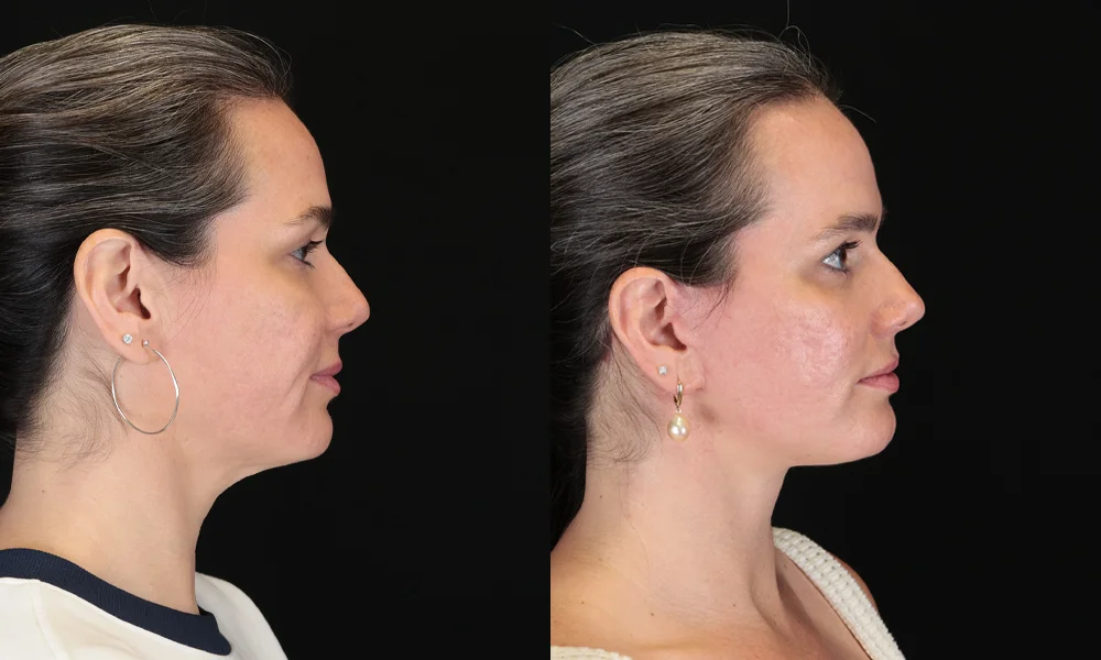 Real patient results in New York, NY Performed by Sameer Halani, MD