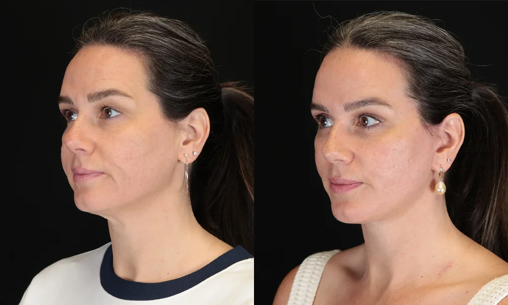 Real patient results in New York, NY Performed by Sameer Halani, MD