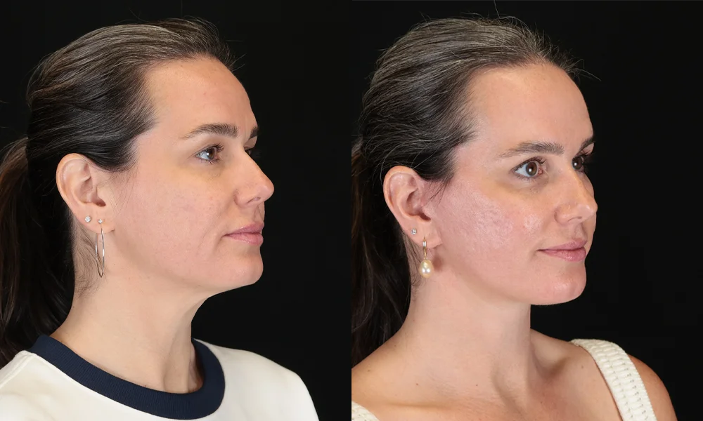 Real patient results in New York, NY Performed by Sameer Halani, MD