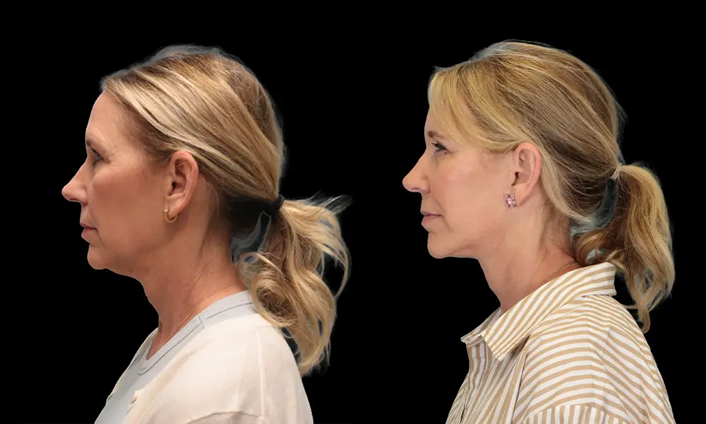 Real patient results in New York, NY Performed by Sameer Halani, MD