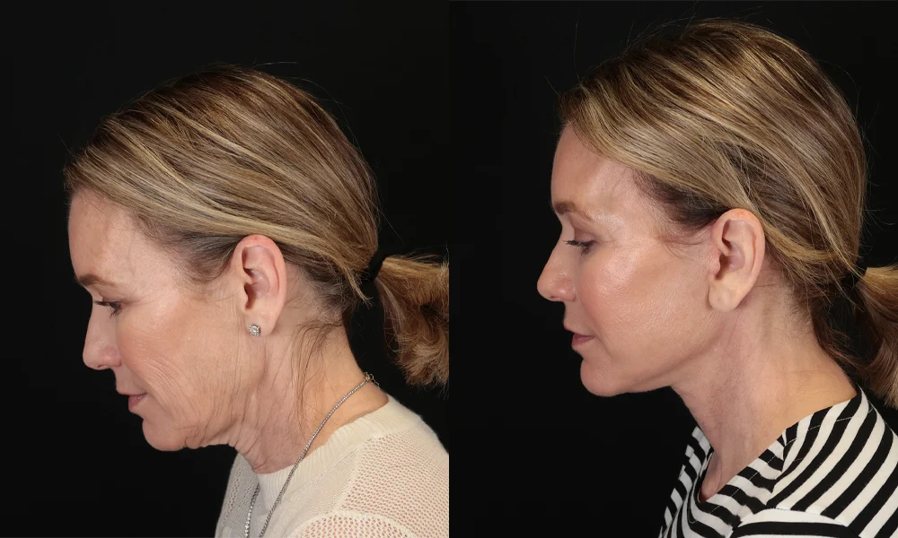 Real patient results in New York, NY Performed by Sameer Halani, MD