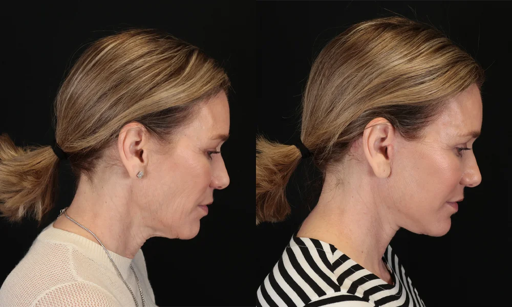 Real patient results in New York, NY Performed by Sameer Halani, MD