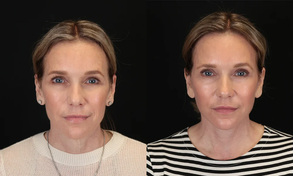 Real patient results in New York, NY Performed by Sameer Halani, MD