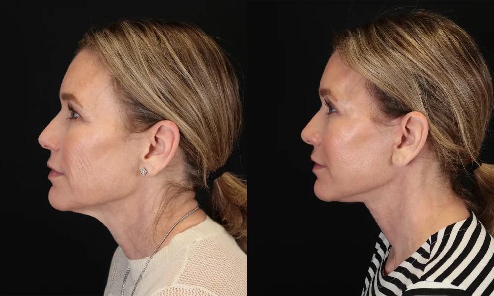 Real patient results in New York, NY Performed by Sameer Halani, MD