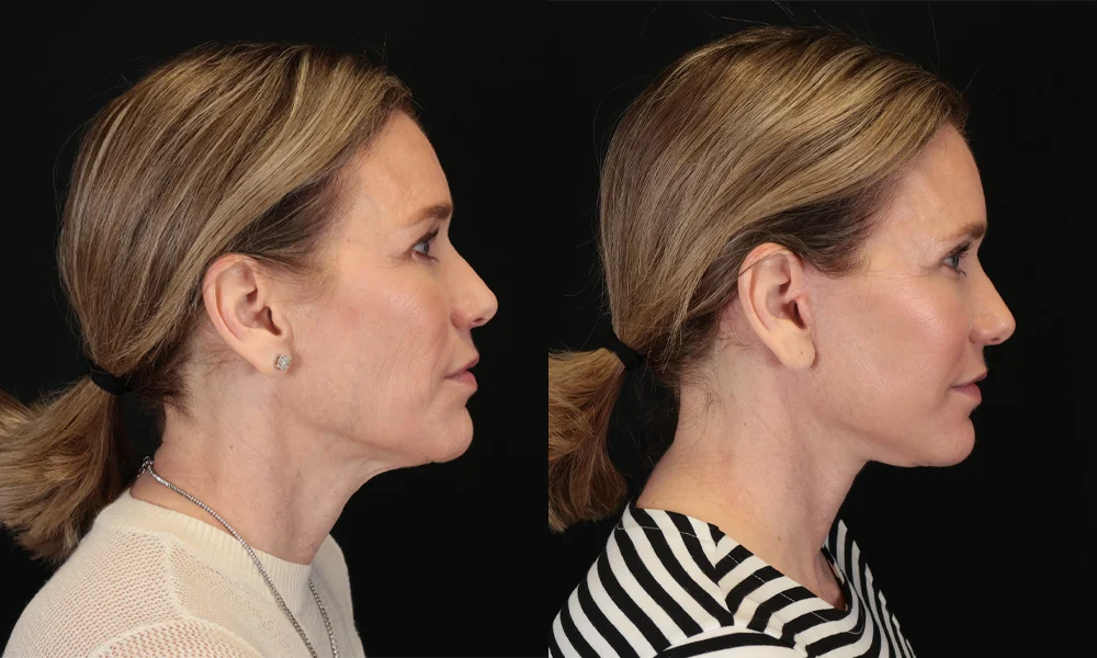 Real patient results in New York, NY Performed by Sameer Halani, MD