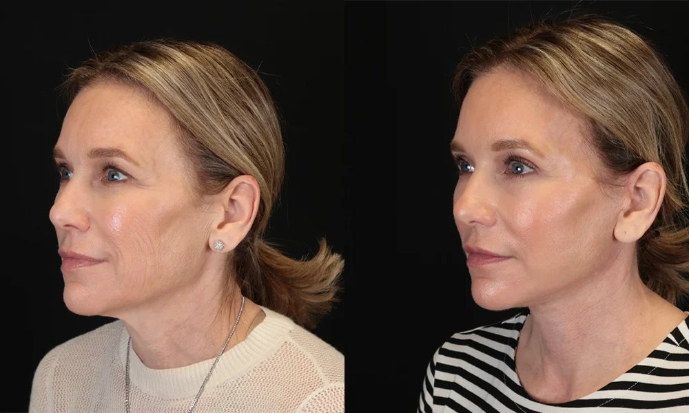 Real patient results in New York, NY Performed by Sameer Halani, MD