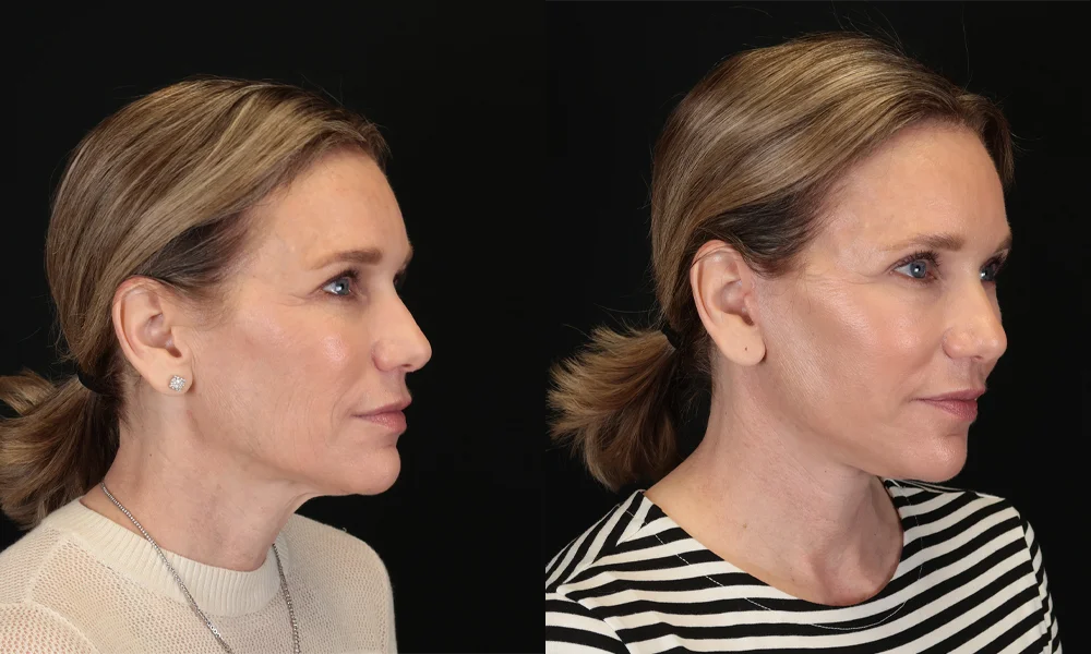 Real patient results in New York, NY Performed by Sameer Halani, MD