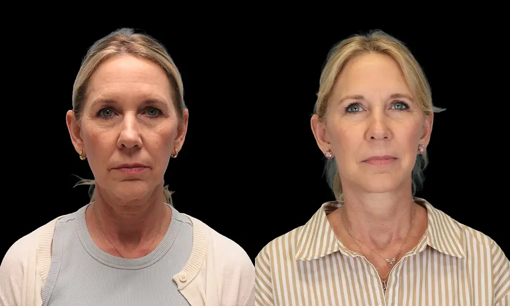 Real patient results in New York, NY Performed by Sameer Halani, MD