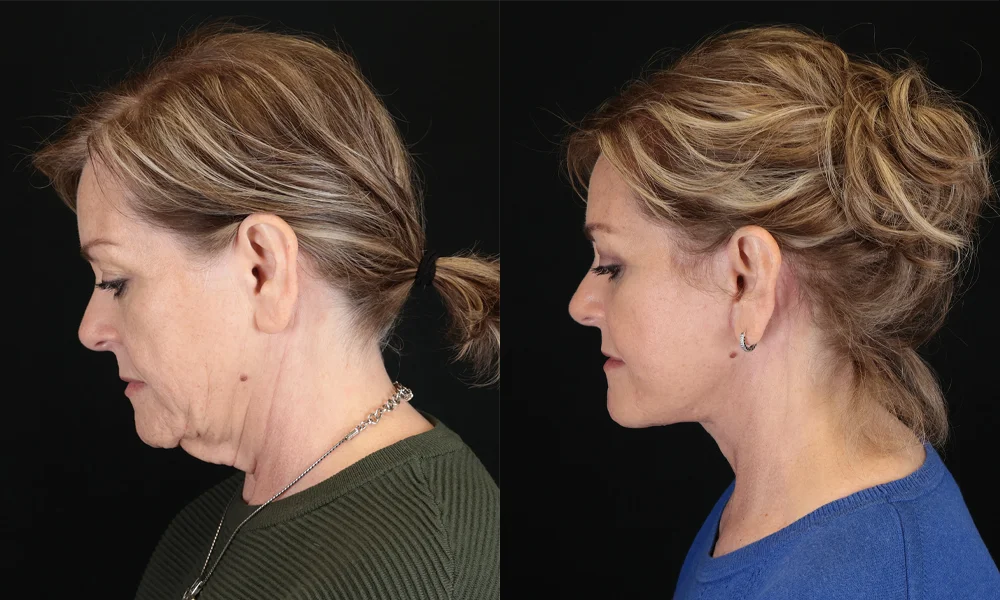 Real patient results in New York, NY Performed by Sameer Halani, MD