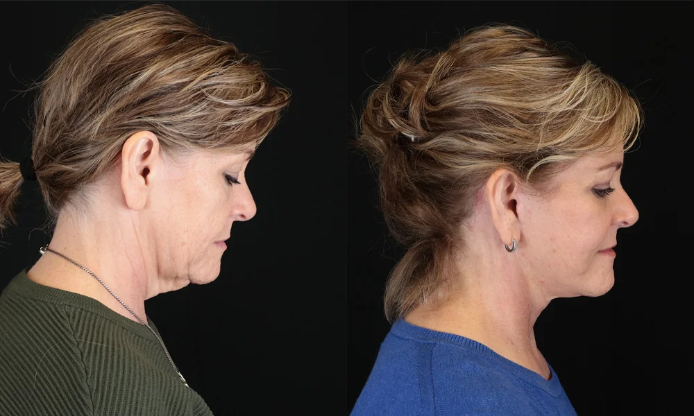 Real patient results in New York, NY Performed by Sameer Halani, MD