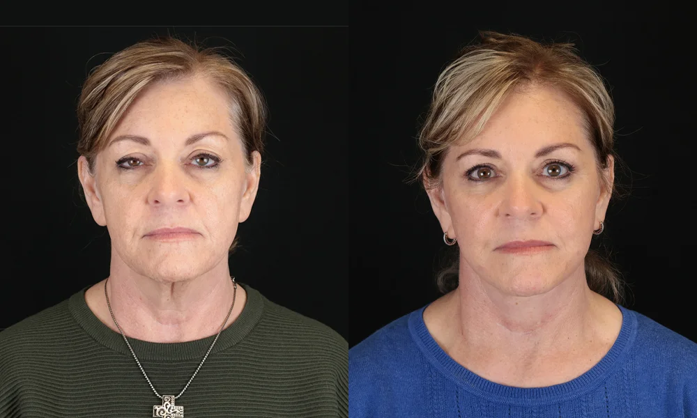 Real patient results in New York, NY Performed by Sameer Halani, MD