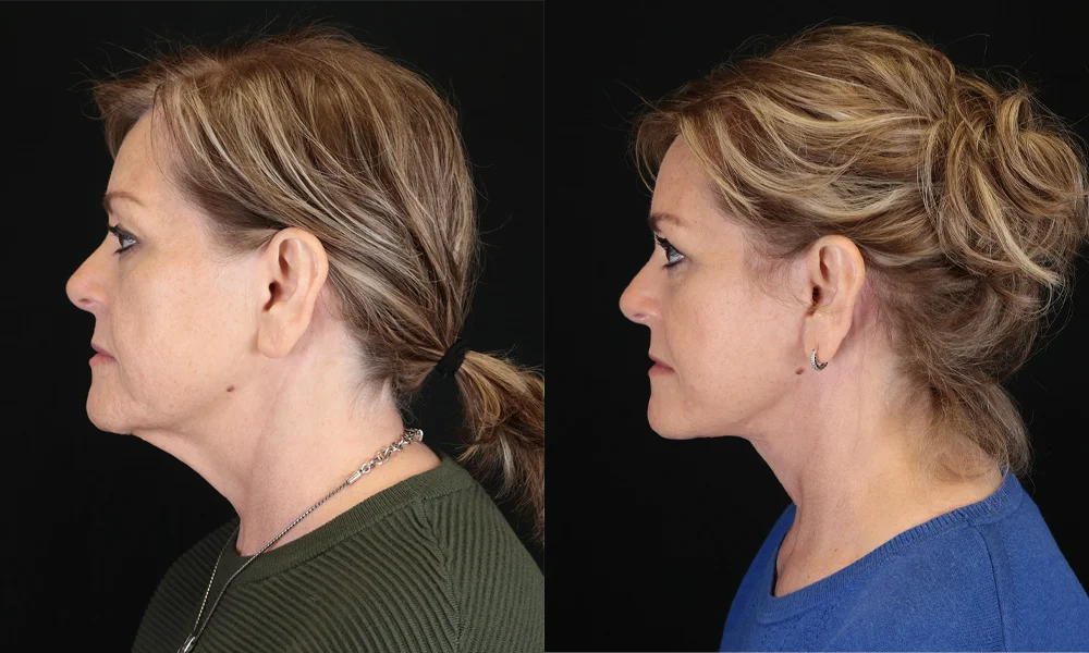 Real patient results in New York, NY Performed by Sameer Halani, MD
