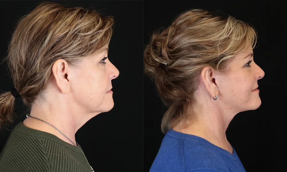 Real patient results in New York, NY Performed by Sameer Halani, MD