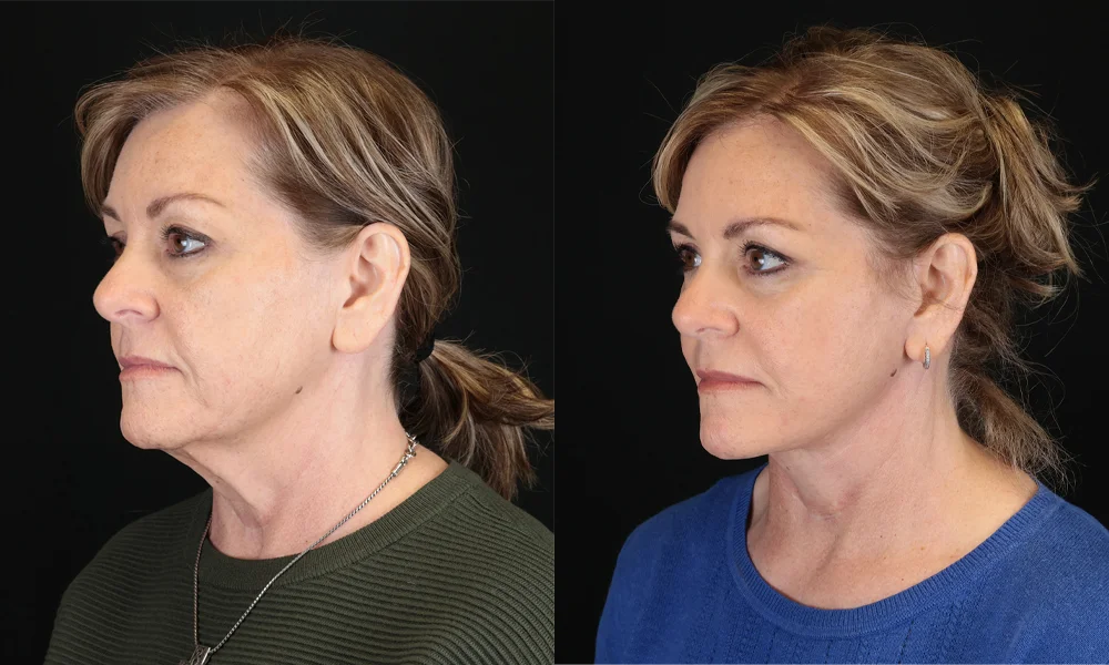 Real patient results in New York, NY Performed by Sameer Halani, MD