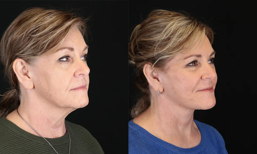 Real patient results in New York, NY Performed by Sameer Halani, MD