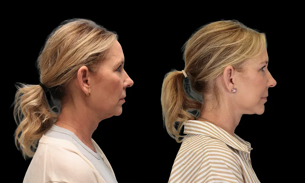 Real patient results in New York, NY Performed by Sameer Halani, MD