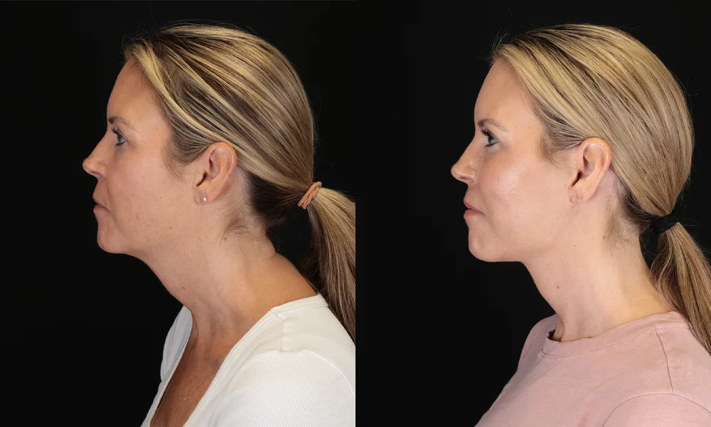 Real patient results in New York, NY Performed by Sameer Halani, MD