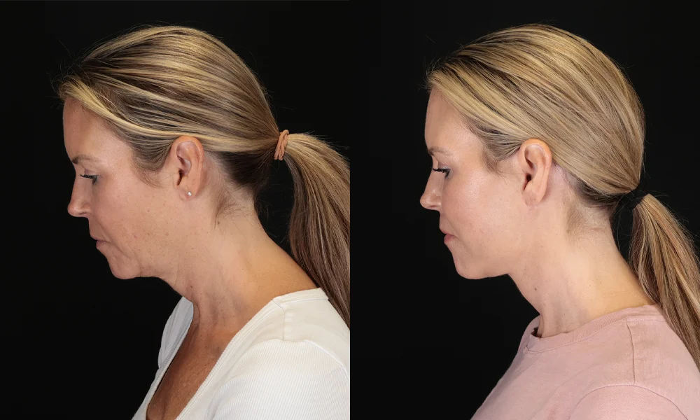 Real patient results in New York, NY Performed by Sameer Halani, MD