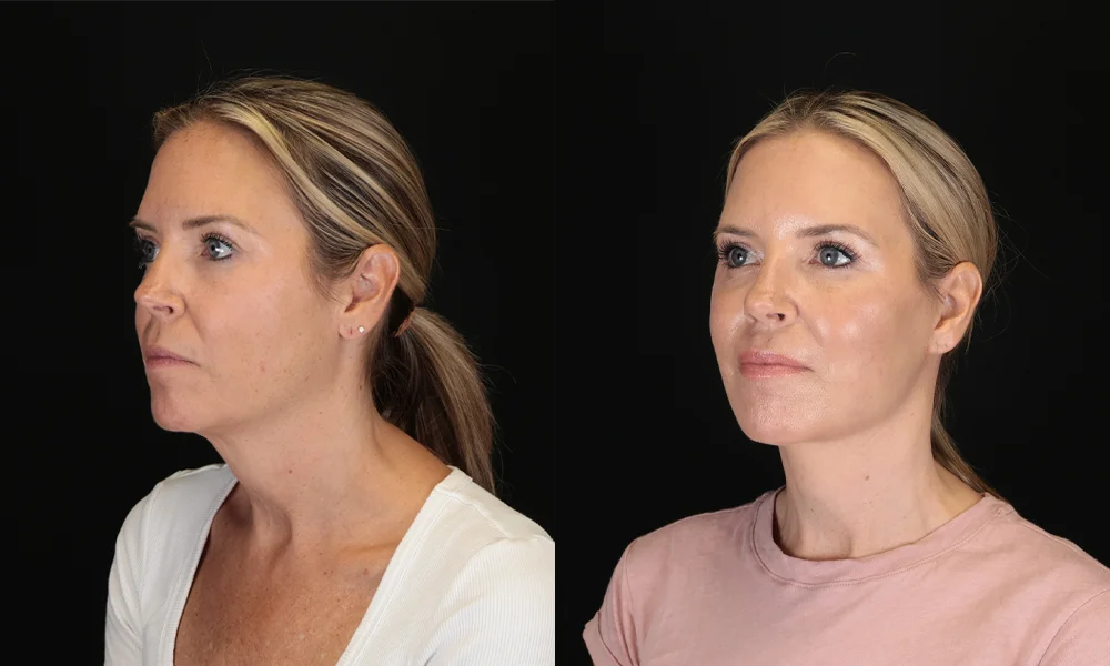 Real patient results in New York, NY Performed by Sameer Halani, MD