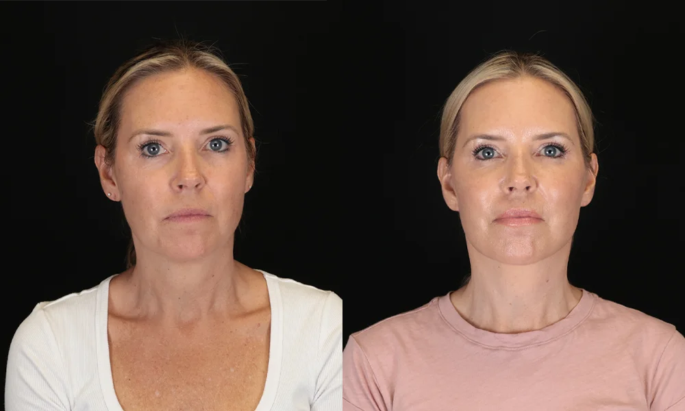 Real patient results in New York, NY Performed by Sameer Halani, MD