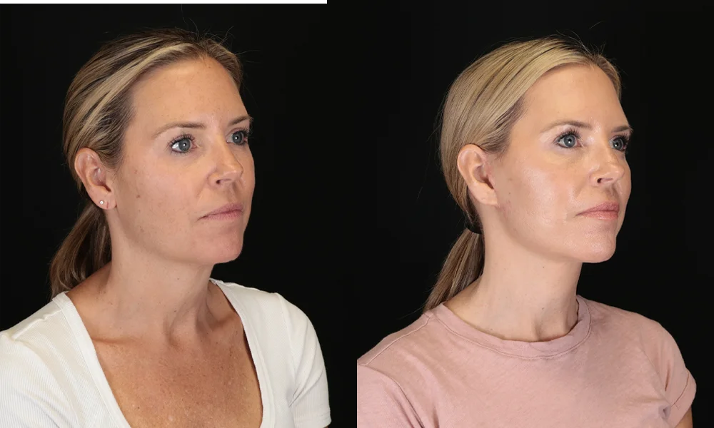 Real patient results in New York, NY Performed by Sameer Halani, MD