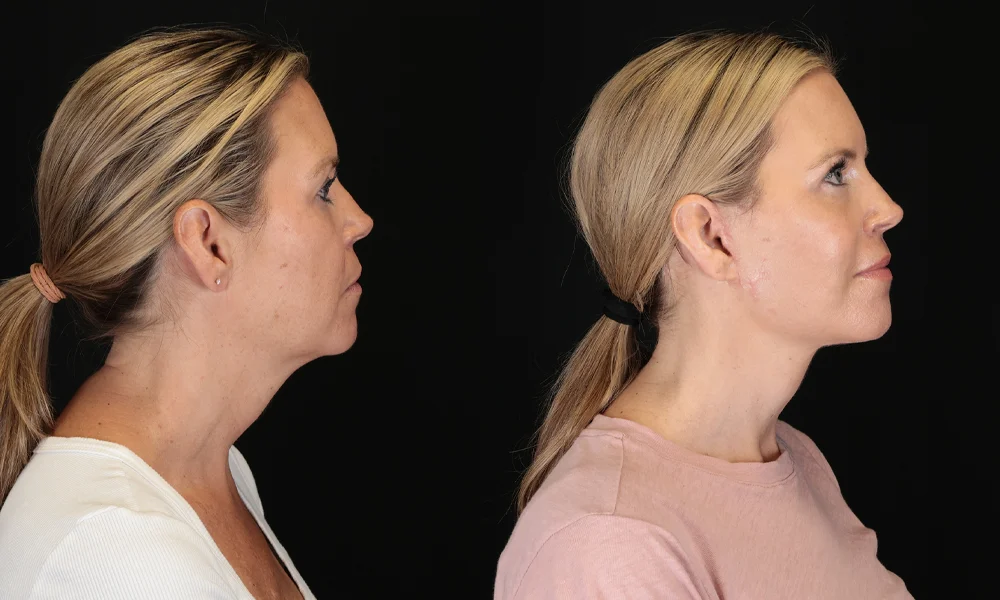 Real patient results in New York, NY Performed by Sameer Halani, MD