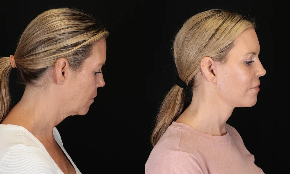 Real patient results in New York, NY Performed by Sameer Halani, MD
