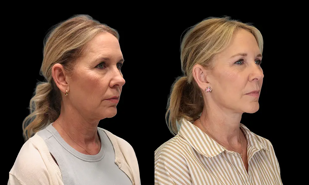 Real patient results in New York, NY Performed by Sameer Halani, MD