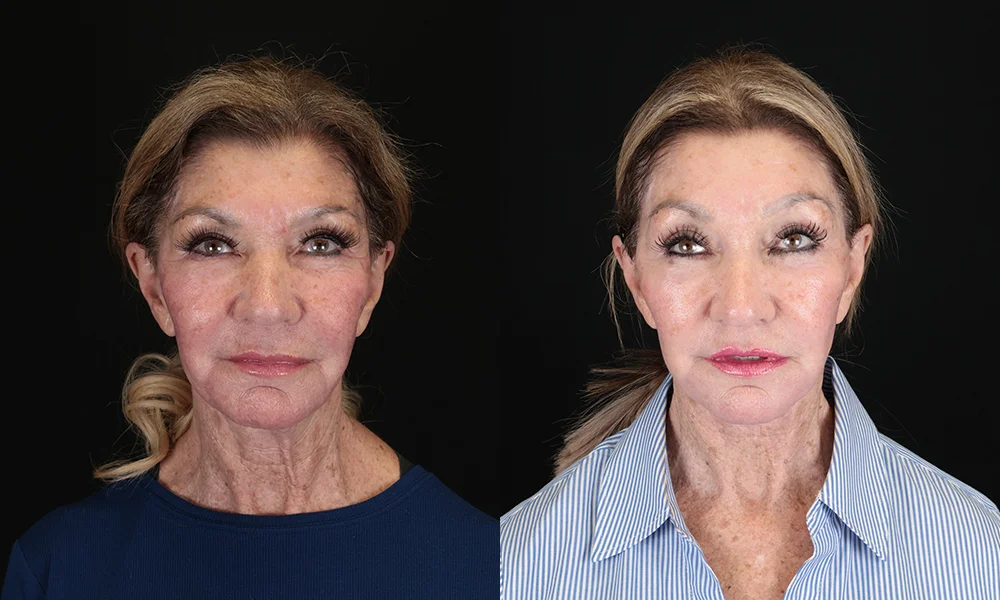 Real patient results in New York, NY Performed by Sameer Halani, MD