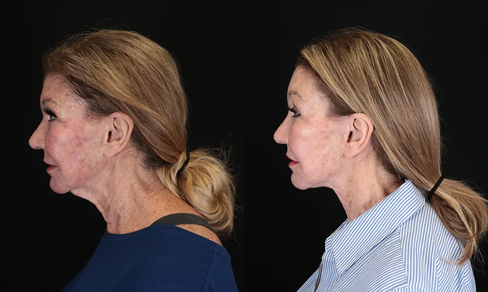 Real patient results in New York, NY Performed by Sameer Halani, MD