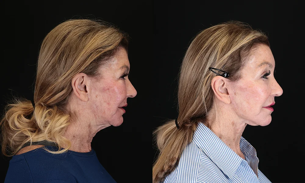 Real patient results in New York, NY Performed by Sameer Halani, MD