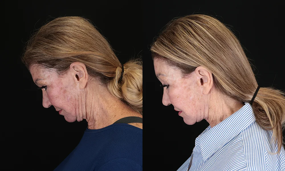 Real patient results in New York, NY Performed by Sameer Halani, MD