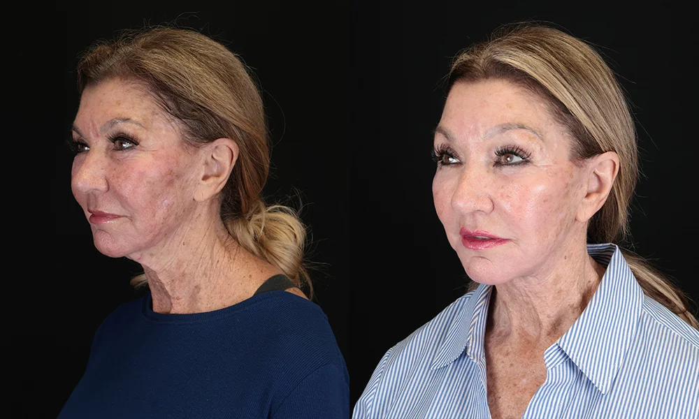 Real patient results in New York, NY Performed by Sameer Halani, MD