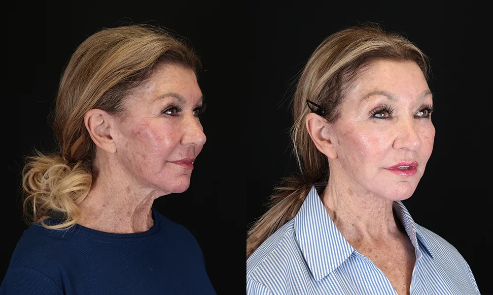 Real patient results in New York, NY Performed by Sameer Halani, MD