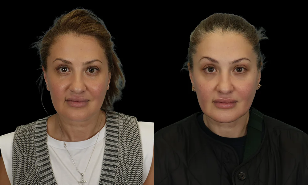 Real patient results in New York, NY Performed by Sameer Halani, MD