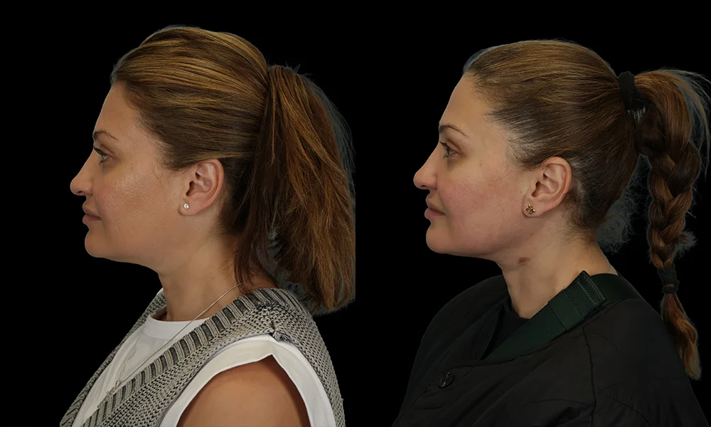 Real patient results in New York, NY Performed by Sameer Halani, MD