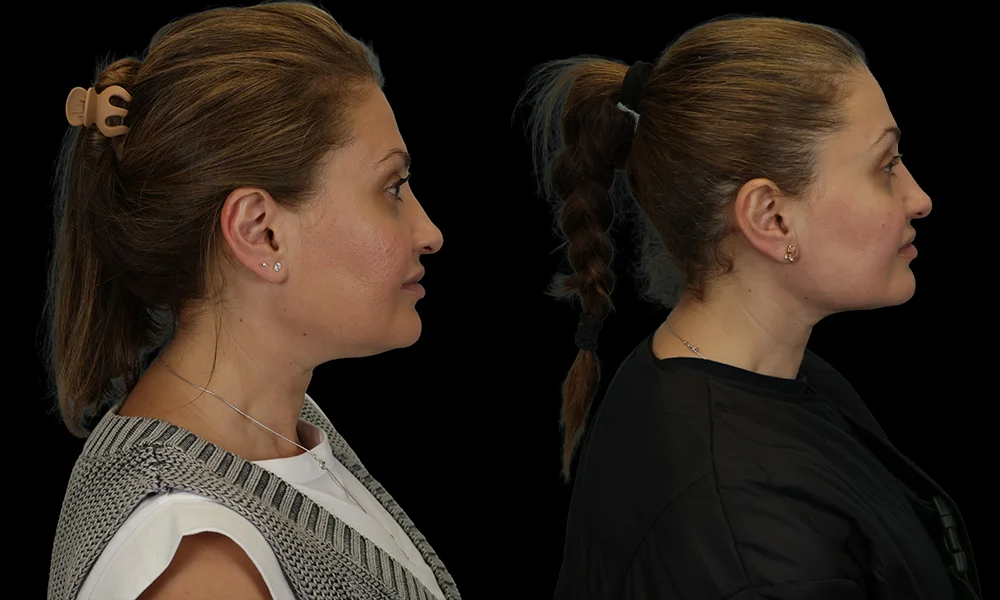 Real patient results in New York, NY Performed by Sameer Halani, MD