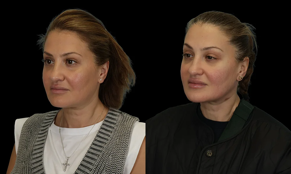 Real patient results in New York, NY Performed by Sameer Halani, MD
