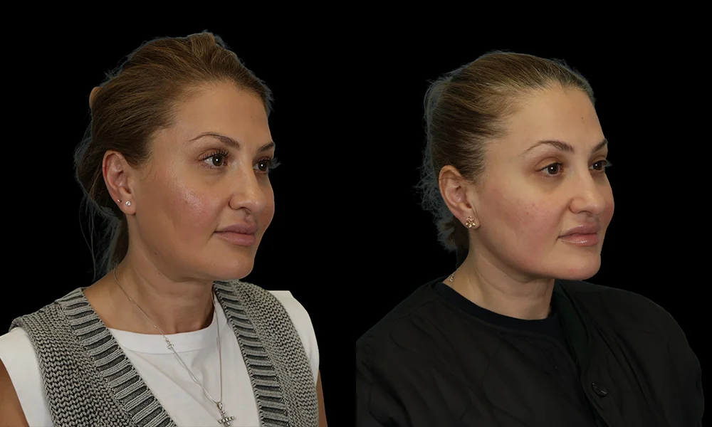 Real patient results in New York, NY Performed by Sameer Halani, MD