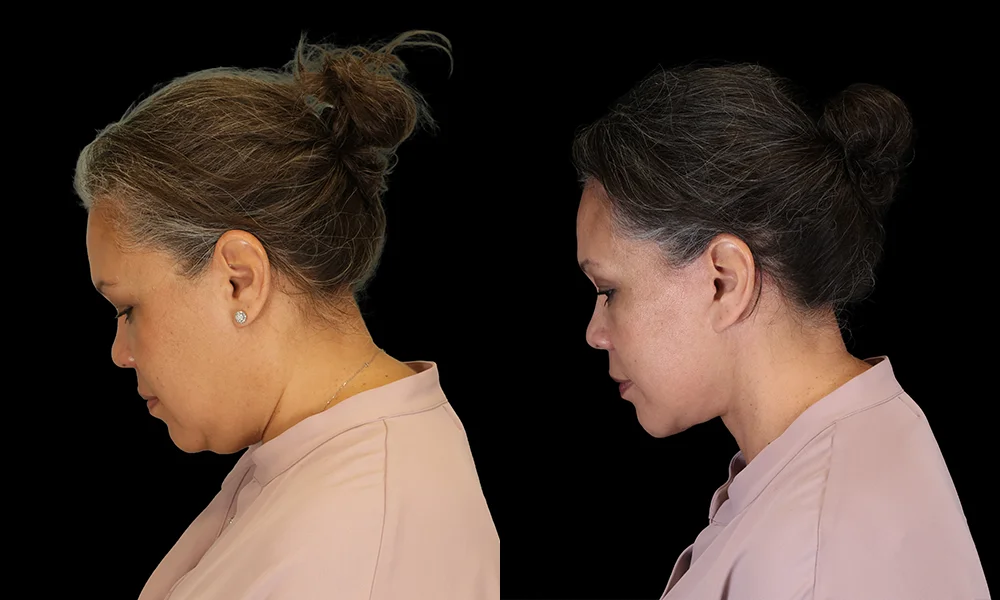 Real patient results in New York, NY Performed by Sameer Halani, MD
