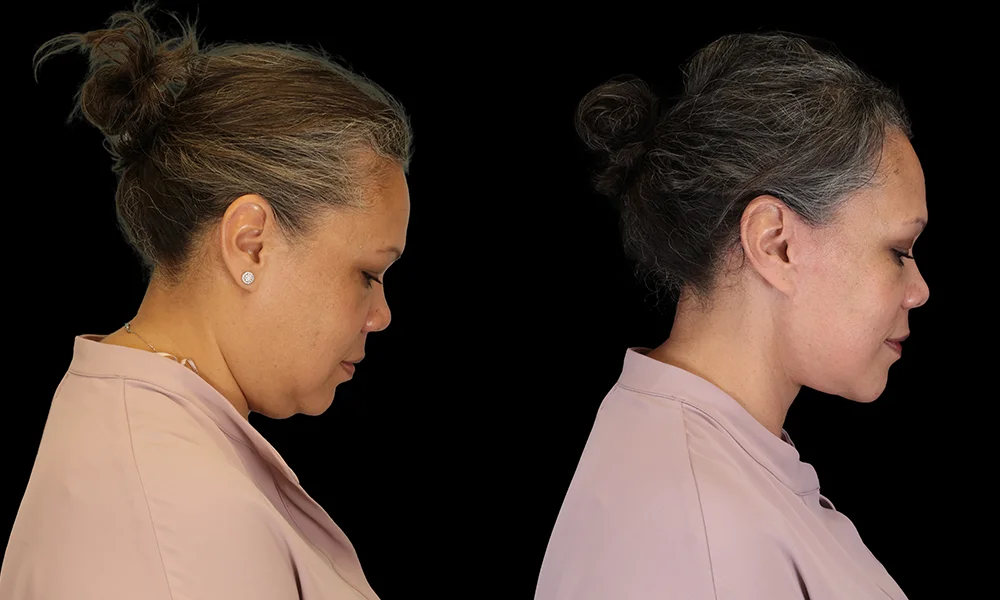 Real patient results in New York, NY Performed by Sameer Halani, MD